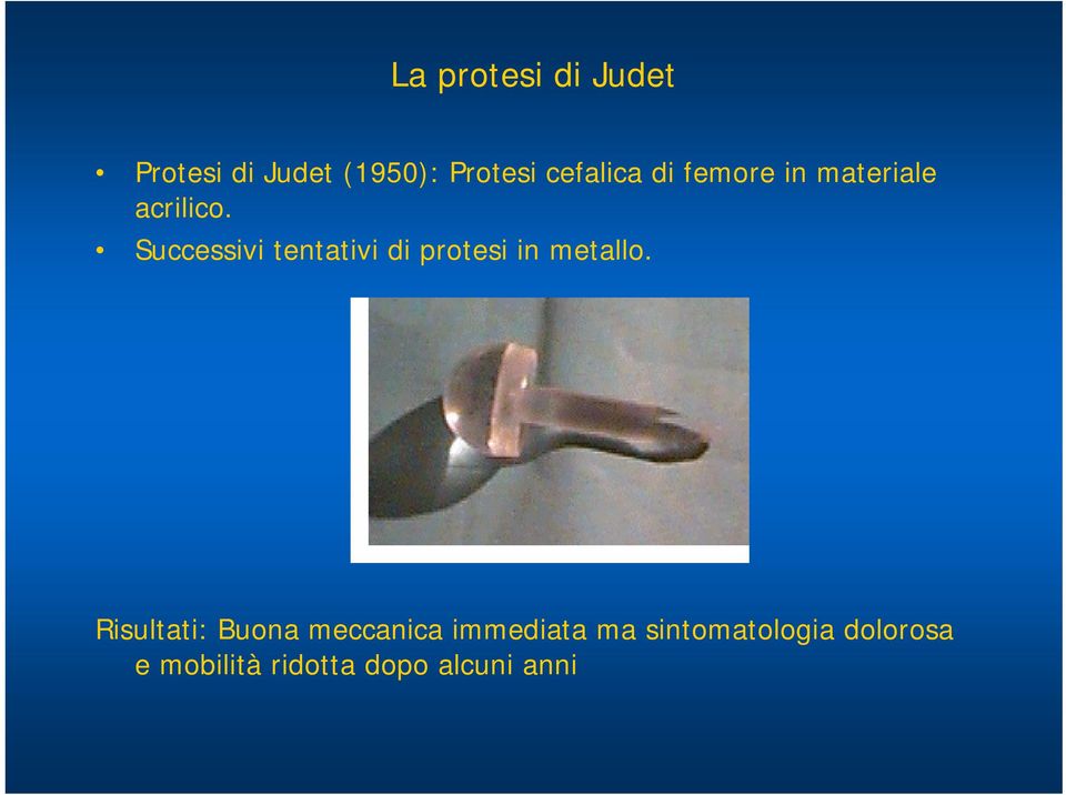Successivi tentativi di protesi in metallo.