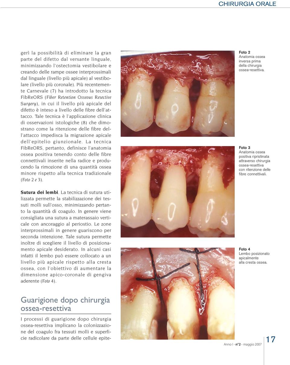 Più recentemente Carnevale (7) ha introdotto la tecnica FibReORS (Fiber Retention Osseous Resective Surgery), in cui il livello più apicale del difetto è inteso a livello delle fibre dell attacco.