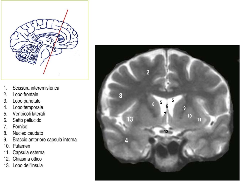 Nucleo caudato 9. Braccio anteriore capsula interna 10.