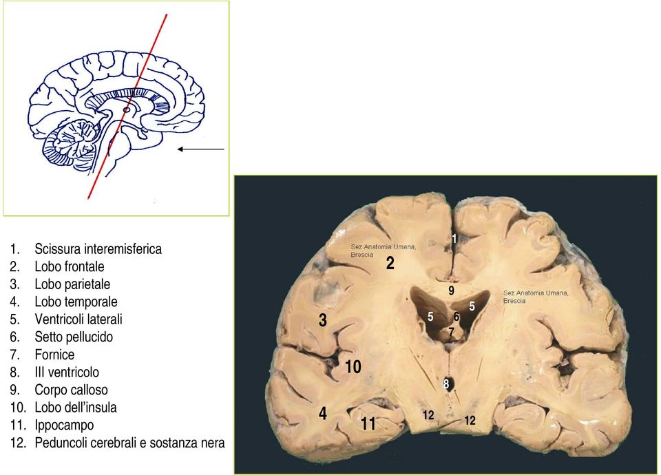 Fornice 8. III ventricolo 9. Corpo calloso 10.