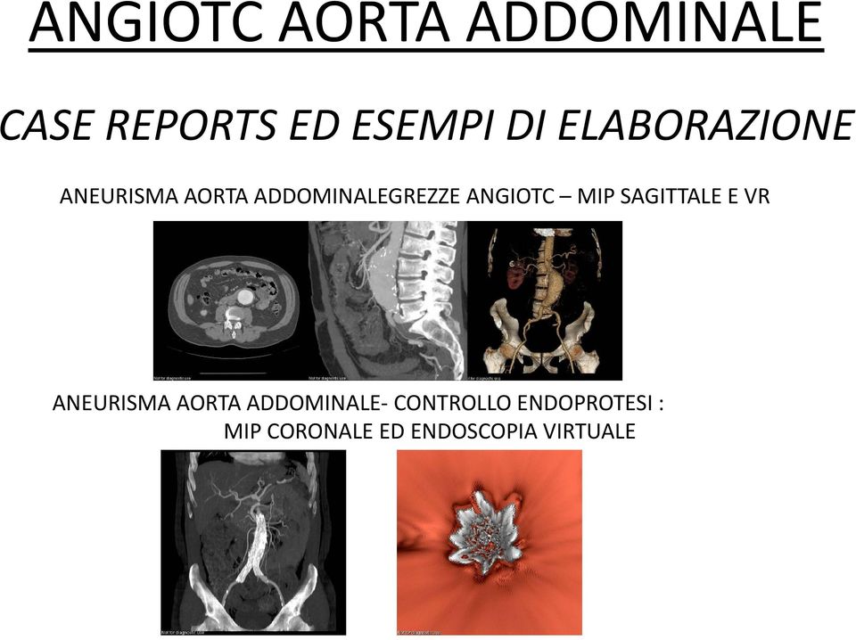 ANGIOTC MIP SAGITTALE E VR ANEURISMA AORTA