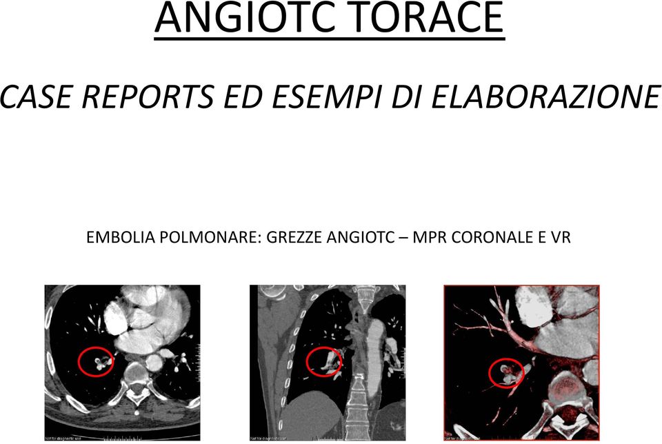 ELABORAZIONE EMBOLIA