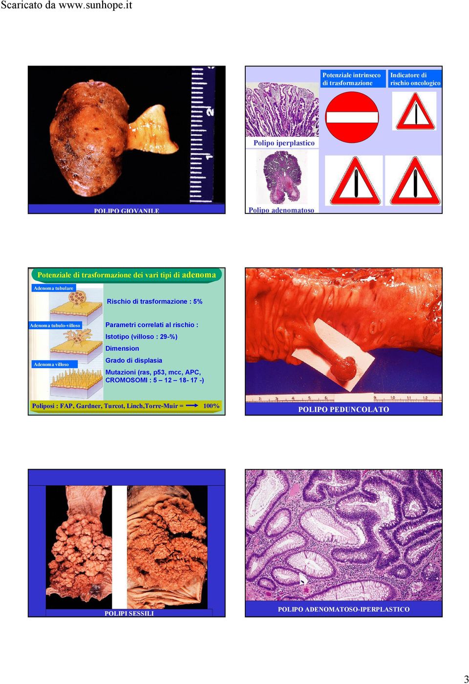 villoso Parametri correlati al rischio : Istotipo (villoso : 29-%) Dimension Grado di displasia Mutazioni (ras, p53, mcc, APC, CROMOSOMI :