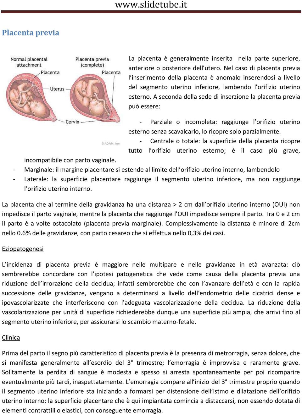 A seconda della sede di inserzione la placenta previa può essere: - Parziale o incompleta: raggiunge l orifizio uterino esterno senza scavalcarlo, lo ricopre solo parzialmente.