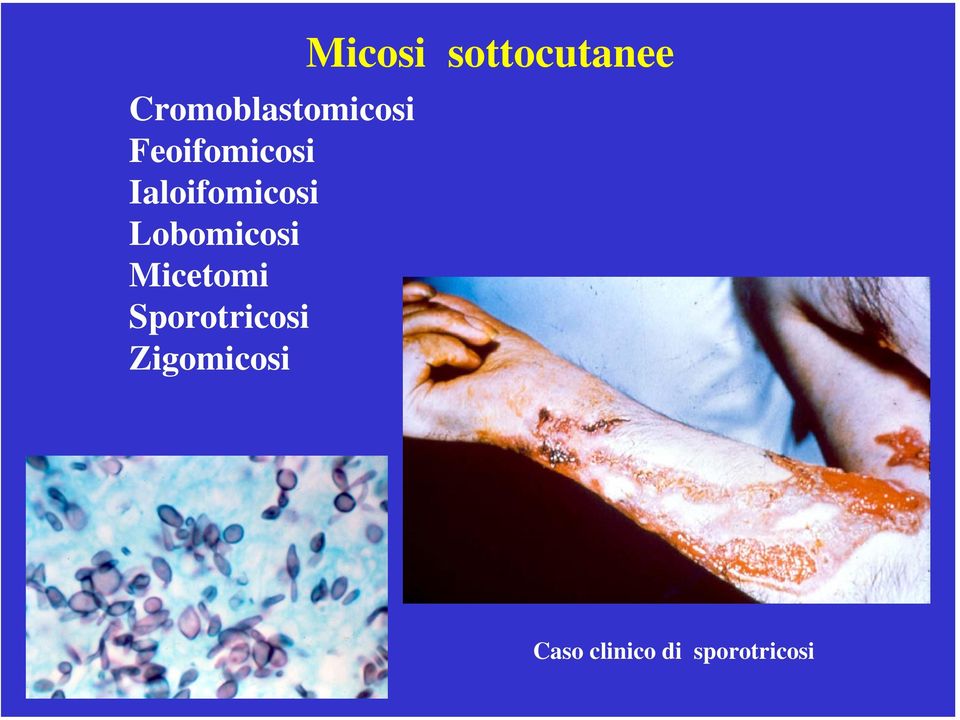 Sporotricosi Zigomicosi Micosi