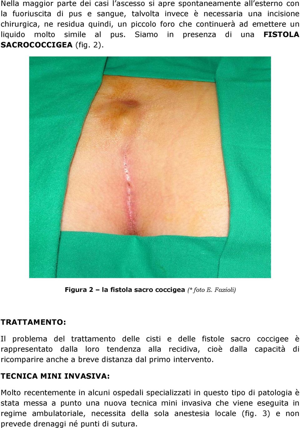 Fazioli) TRATTAMENTO: Il problema del trattamento delle cisti e delle fistole sacro coccigee è rappresentato dalla loro tendenza alla recidiva, cioè dalla capacità di ricomparire anche a breve