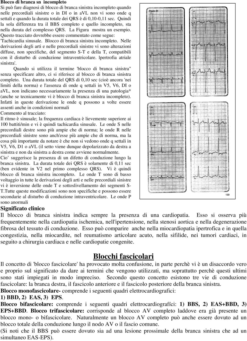 Questo tracciato dovrebbe essere commentato come segue: 'Tachicardia sinusale. Blocco di branca sinistra incompleto.