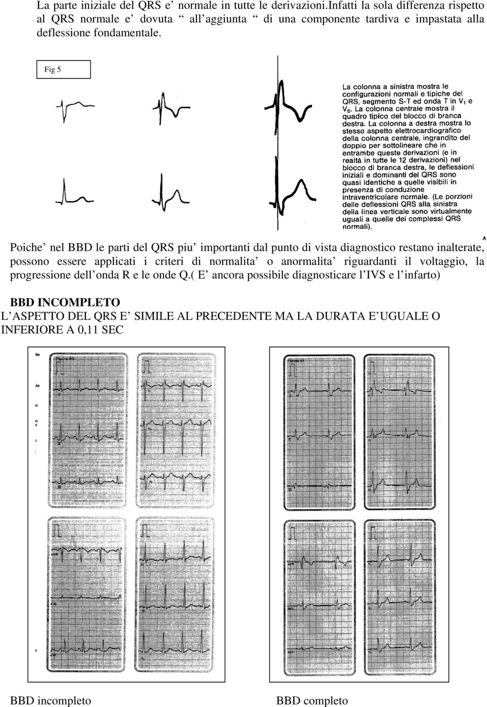 Fig 5 Poiche nel BBD le parti del QRS piu importanti dal punto di vista diagnostico restano inalterate, possono essere applicati i criteri di normalita o