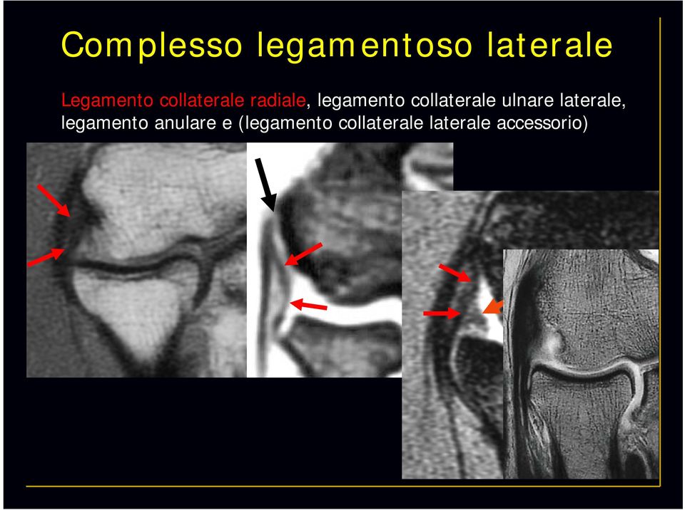 collaterale ulnare laterale, legamento