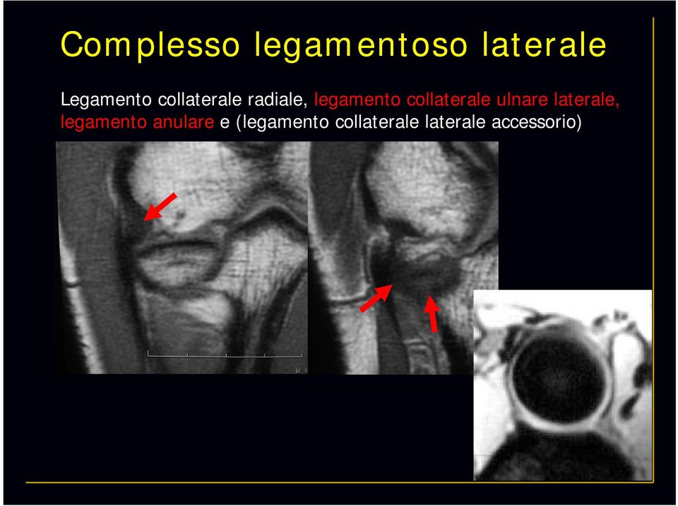 collaterale ulnare laterale, legamento