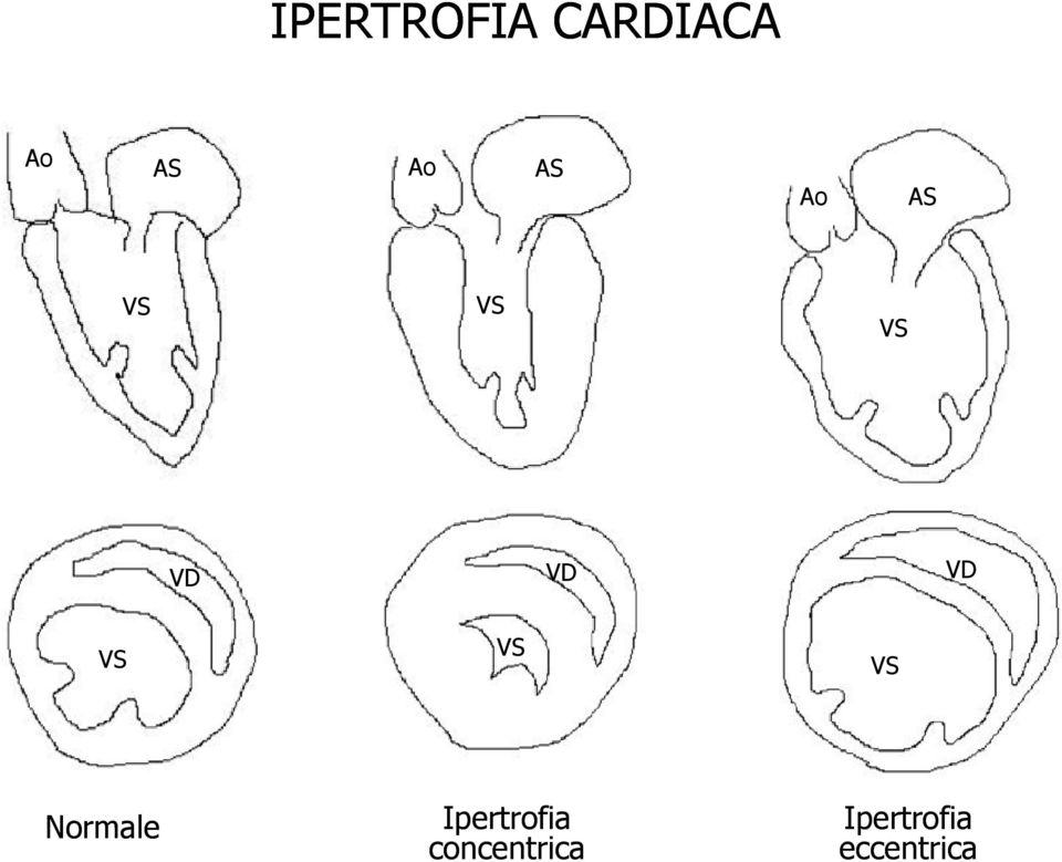 VS VS Normale Ipertrofia