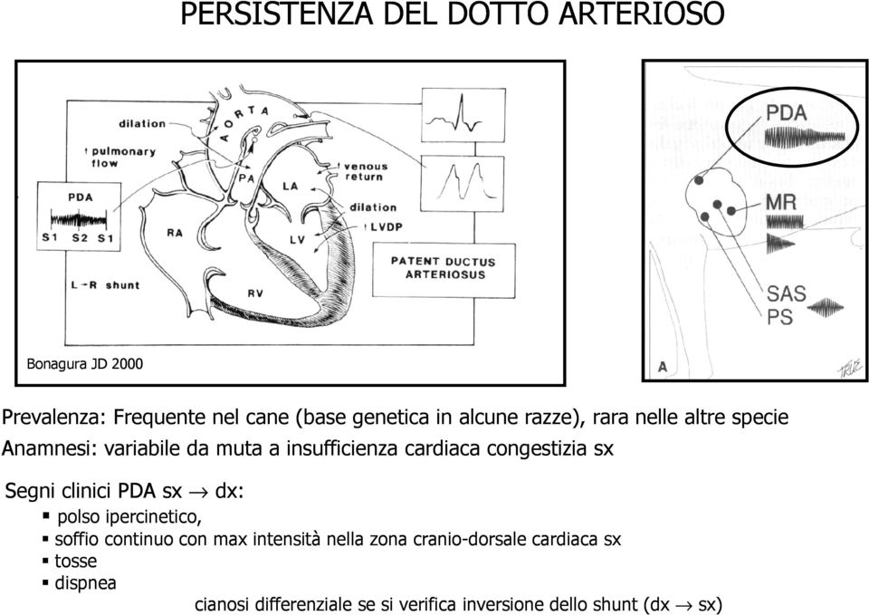 congestizia sx Segni clinici PDA sx dx: polso ipercinetico, soffio continuo con max intensità nella