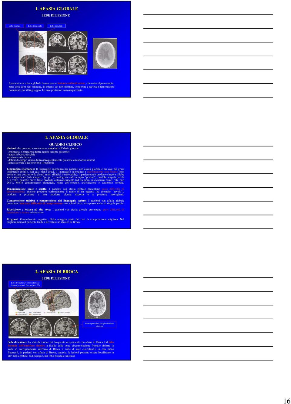 AFASIA GLOBALE QUADRO CLINICO Sintomi che possono a volte essere associati all'afasia globale: - emiplegia o emiparesi destra (quasi sempre presente) - aprassia bucco-facciale - emianestesia destra -