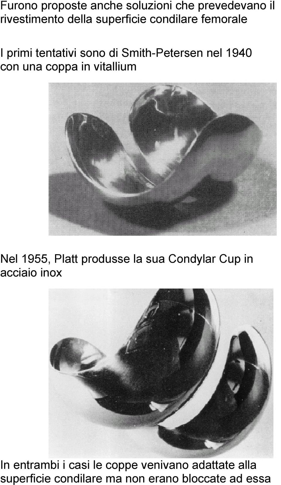 in vitallium Nel 1955, Platt produsse la sua Condylar Cup in acciaio inox In