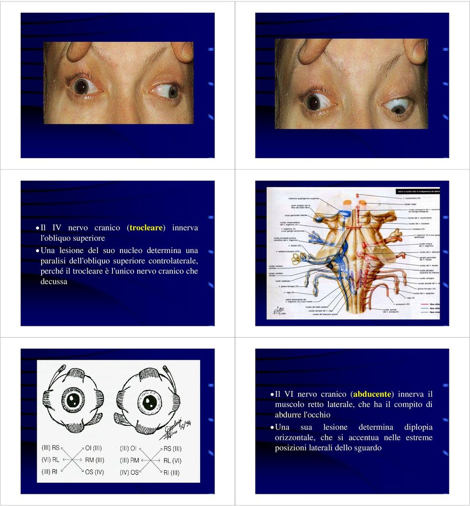 Il VI nervo cranico (abducente) innerva il muscolo retto laterale, che ha il compito di abdurre l'occhio