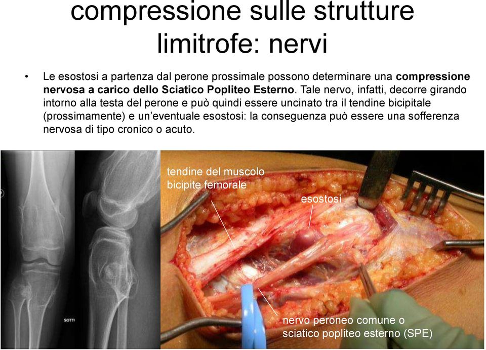 Tale nervo, infatti, decorre girando intorno alla testa del perone e può quindi essere uncinato tra il tendine bicipitale