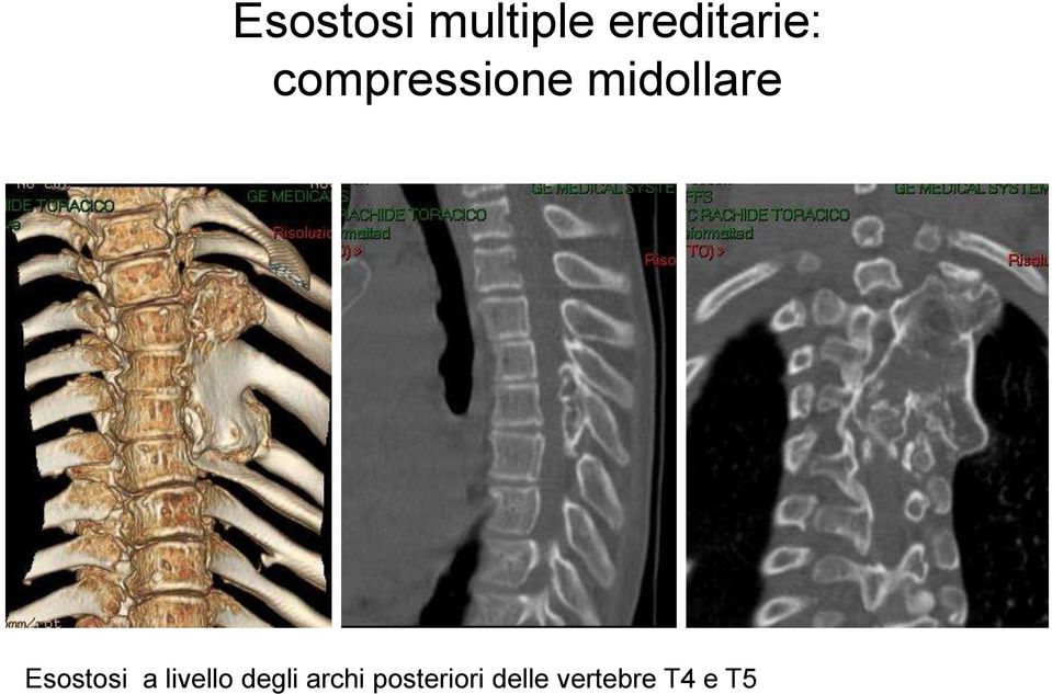 Esostosi a livello degli