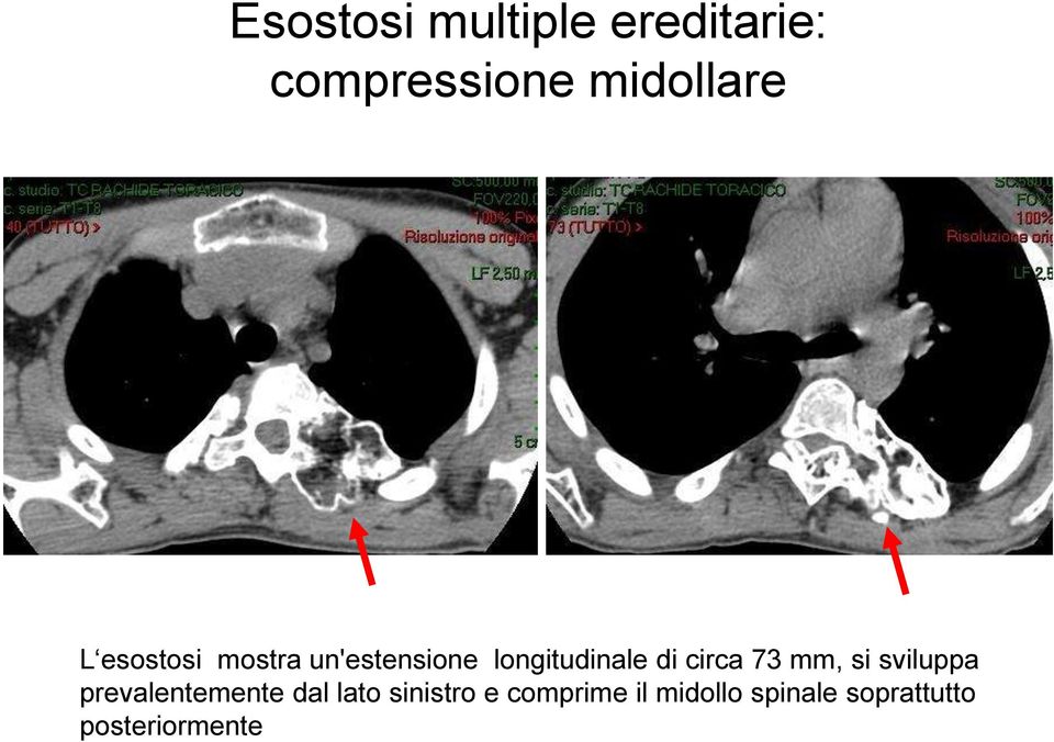 73 mm, si sviluppa prevalentemente dal lato sinistro e