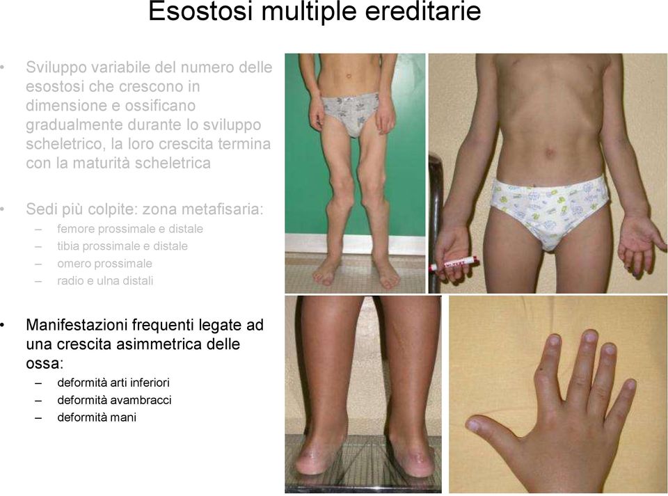 zona metafisaria: femore prossimale e distale tibia prossimale e distale omero prossimale radio e ulna distali