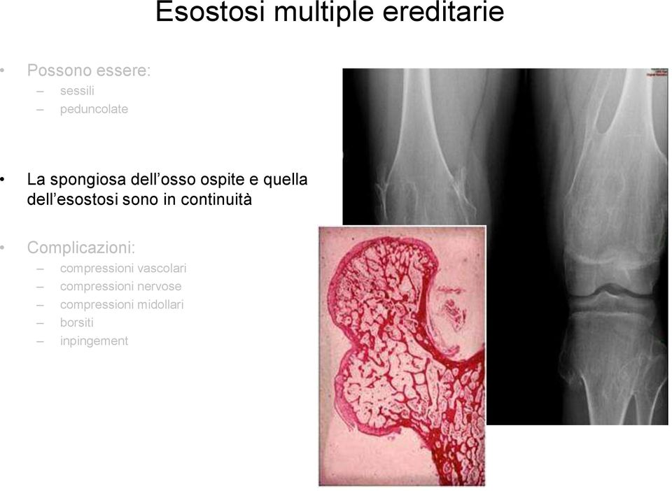 esostosi sono in continuità Complicazioni: compressioni