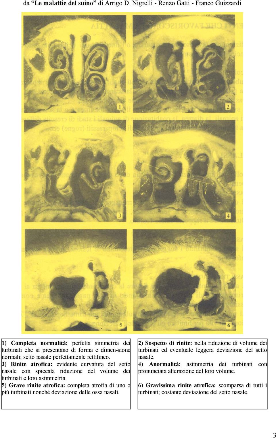 3) Rinite atrofica: evidente curvatura del setto nasale con spiccata riduzione del volume dei turbinati e loro asimmetria.