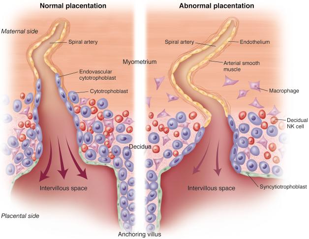 Preeclampsia