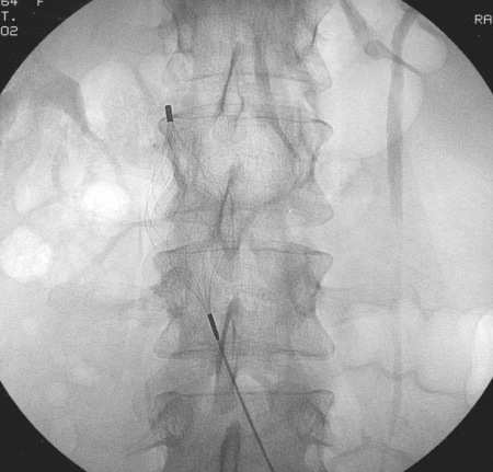 J Thromb Thrombolysis. 2012 Apr;33(3):258-66. Indicazioni: 1.controindicazioni all uso di anticoagulanti 2.fallimento di terapia anticoagulante 3.profilassi nei pazienti ad alto rischio 4.