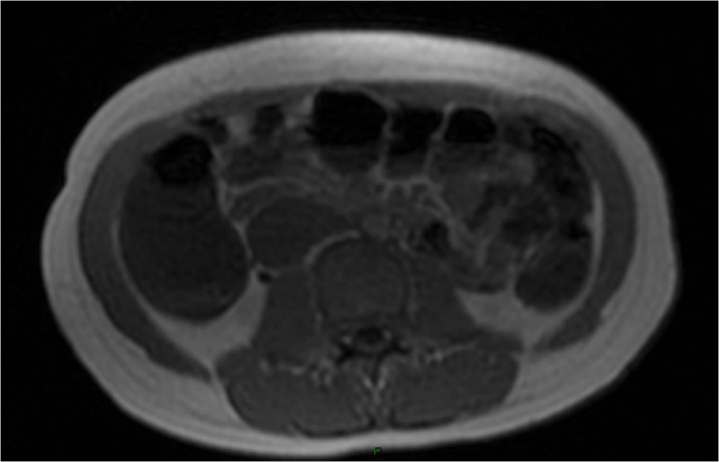 Entero-RMN Linfangioma?