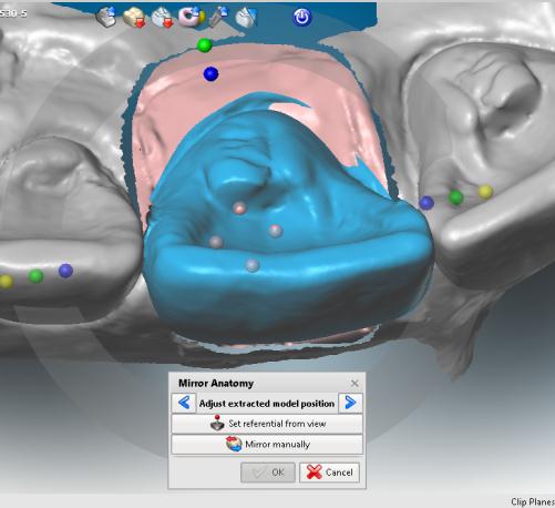 Le seguenti immagini mostrano che il software rispecchierà automaticamente l'anatomia quando il dente centrale in alto a destra è stato progettato (foto a sinistra).