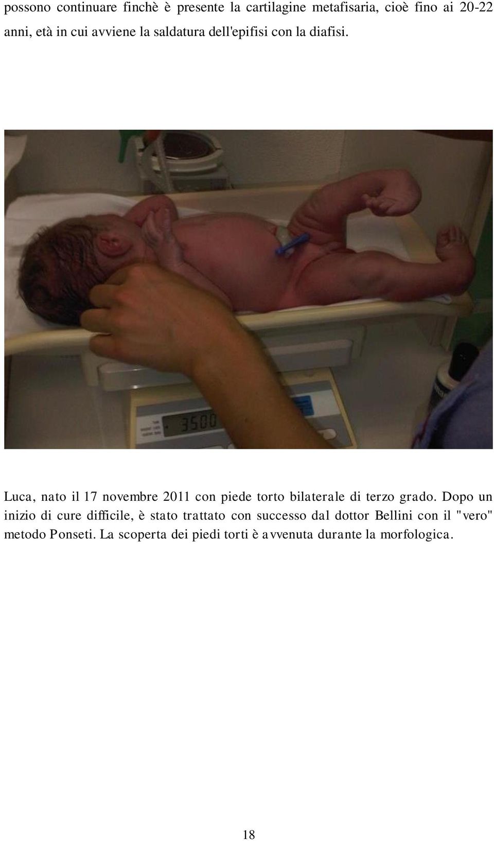 Luca, nato il 17 novembre 2011 con piede torto bilaterale di terzo grado.