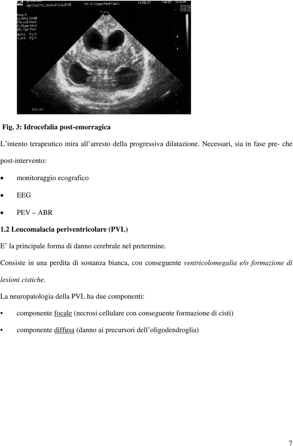 2 Leucomalacia periventricolare (PVL) E la principale forma di danno cerebrale nel pretermine.