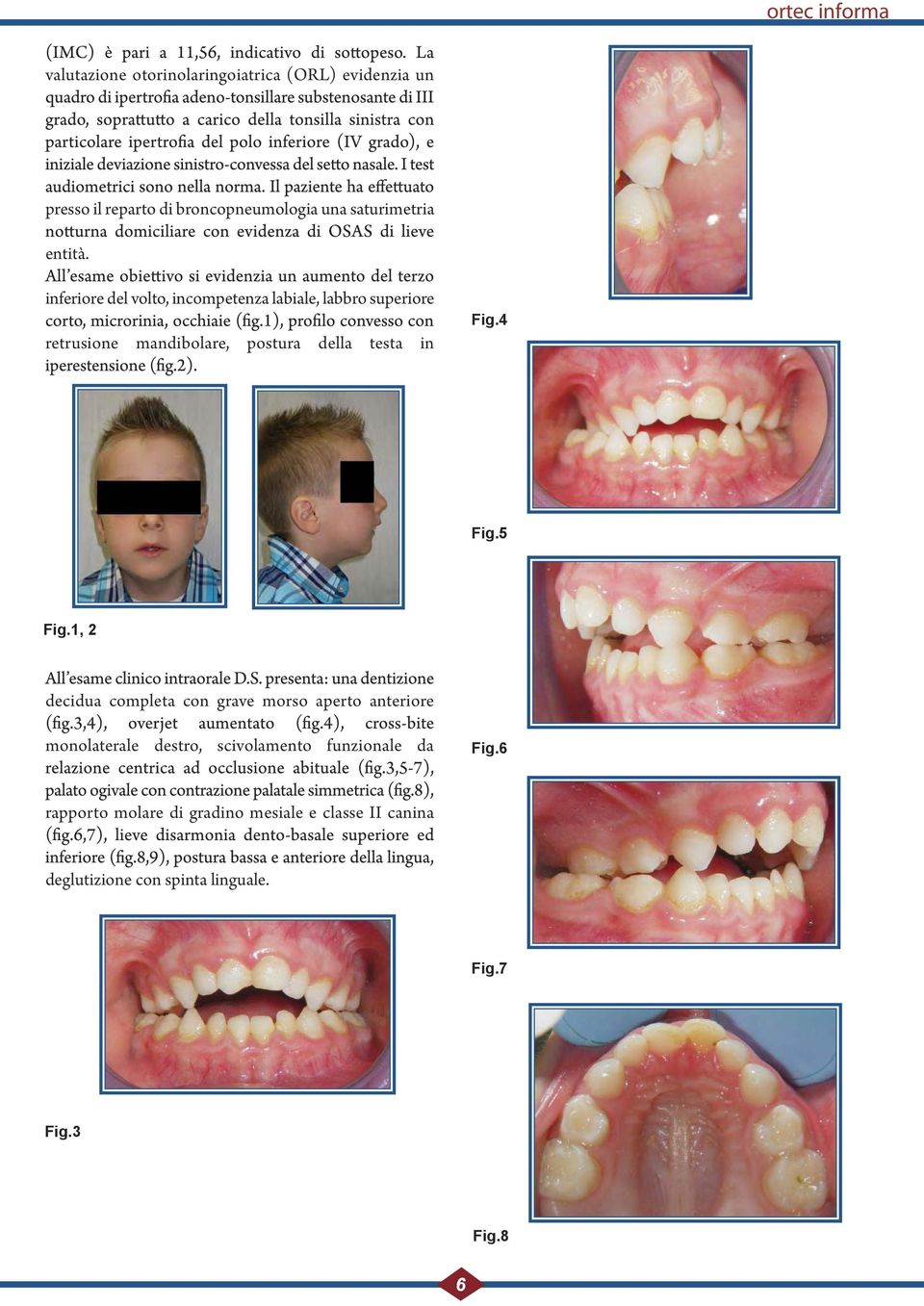 inferiore del volto, incompetenza labiale, labbro superiore retrusione mandibolare, postura della testa in Fig.