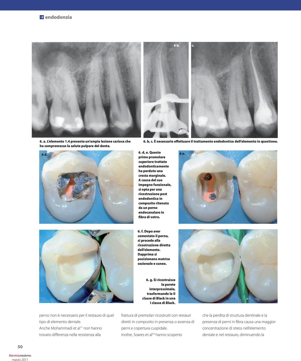 A causa del suo impegno funzionale, si opta per una ricostruzione post endodontica in composito ritenuta da un perno endocanalare in fibra di vetro. 6 e. 6. b, c.