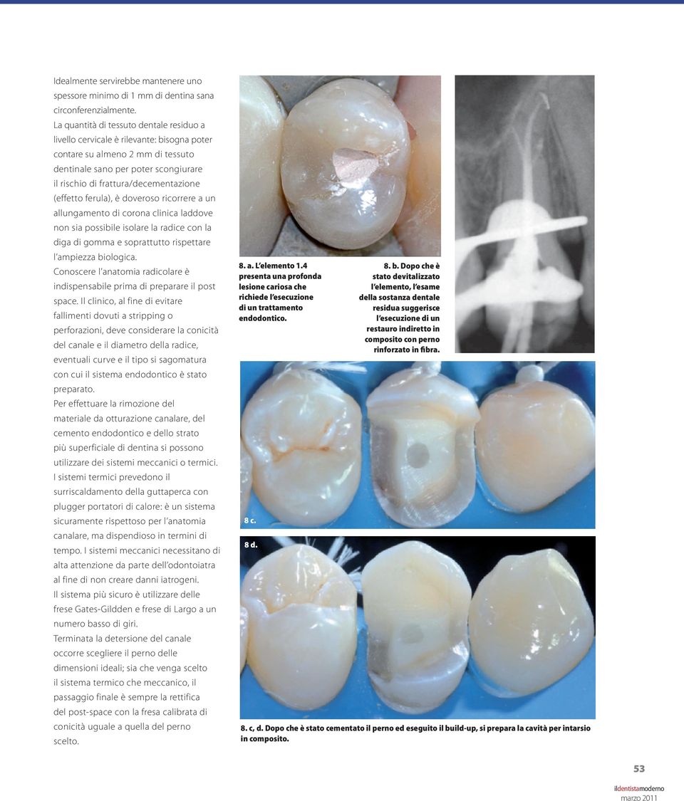 (effetto ferula), è doveroso ricorrere a un allungamento di corona clinica laddove non sia possibile isolare la radice con la diga di gomma e soprattutto rispettare l ampiezza biologica.