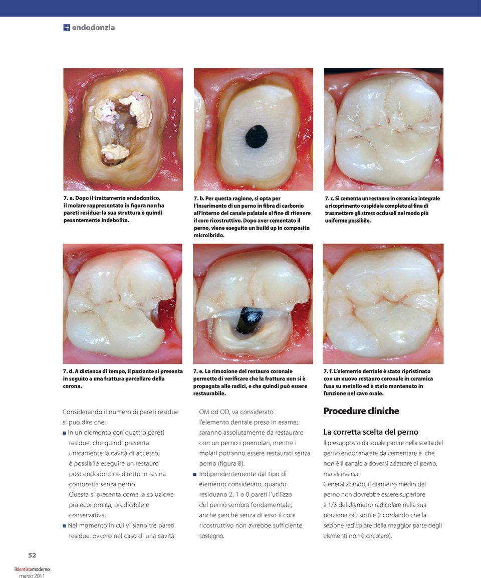 Dopo aver cementato il perno, viene eseguito un build up in composito microibrido. 7. c. Si cementa un restauro in ceramica integrale a ricoprimento cuspidale completo al fine di trasmettere gli stress occlusali nel modo più uniforme possibile.