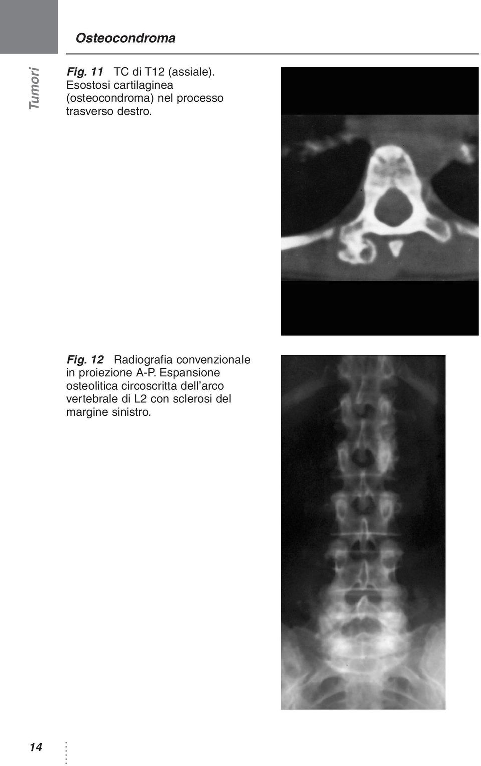 destro. Fig. 12 Radiografia convenzionale in proiezione A-P.