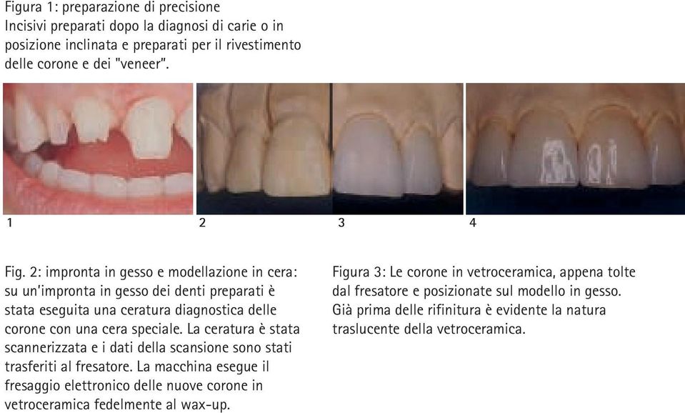 La ceratura è stata scannerizzata e i dati della scansione sono stati trasferiti al fresatore.