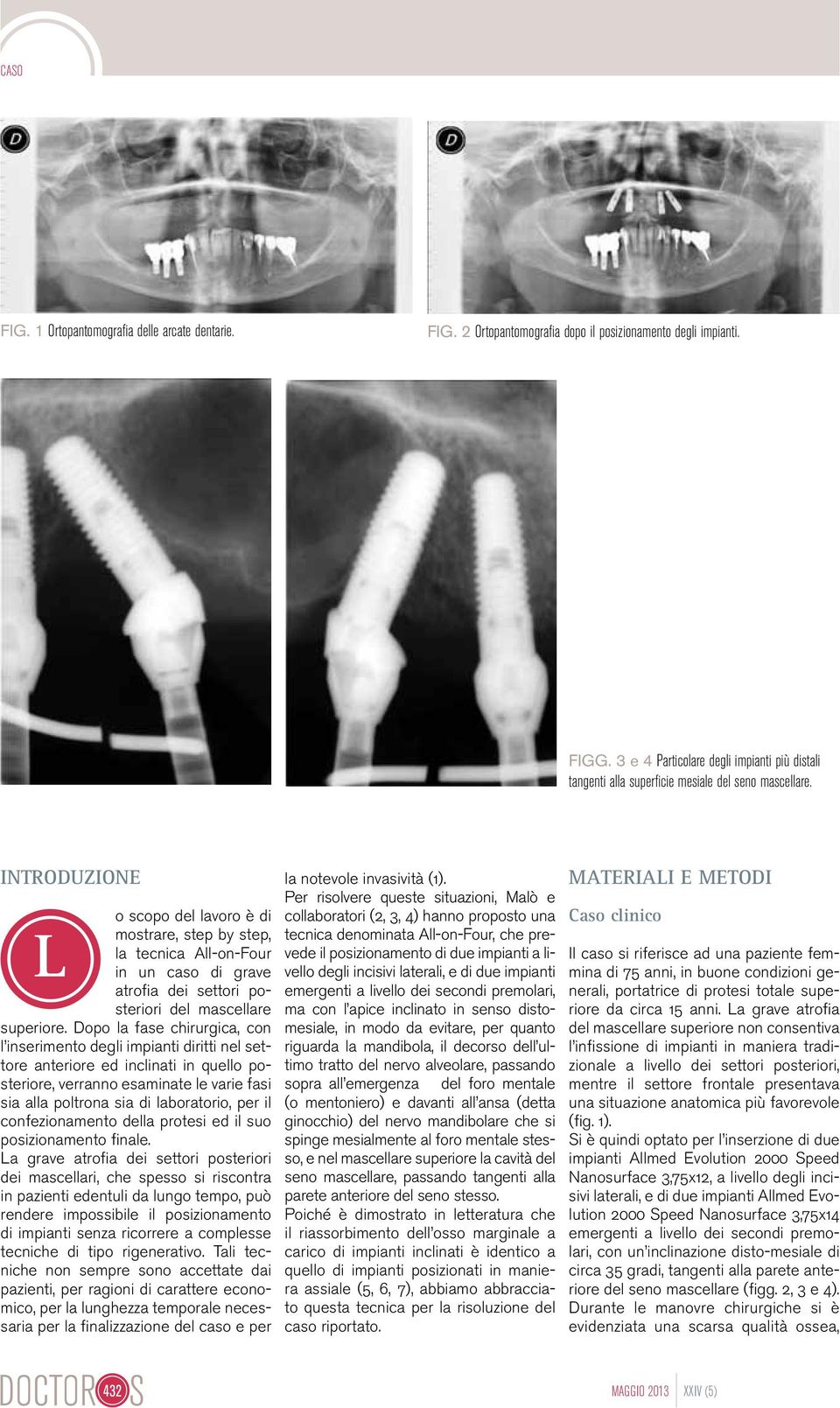 Introduzione o scopo del lavoro è di L mostrare, step by step, la tecnica All-on-Four in un caso di grave atrofia dei settori posteriori del mascellare superiore.