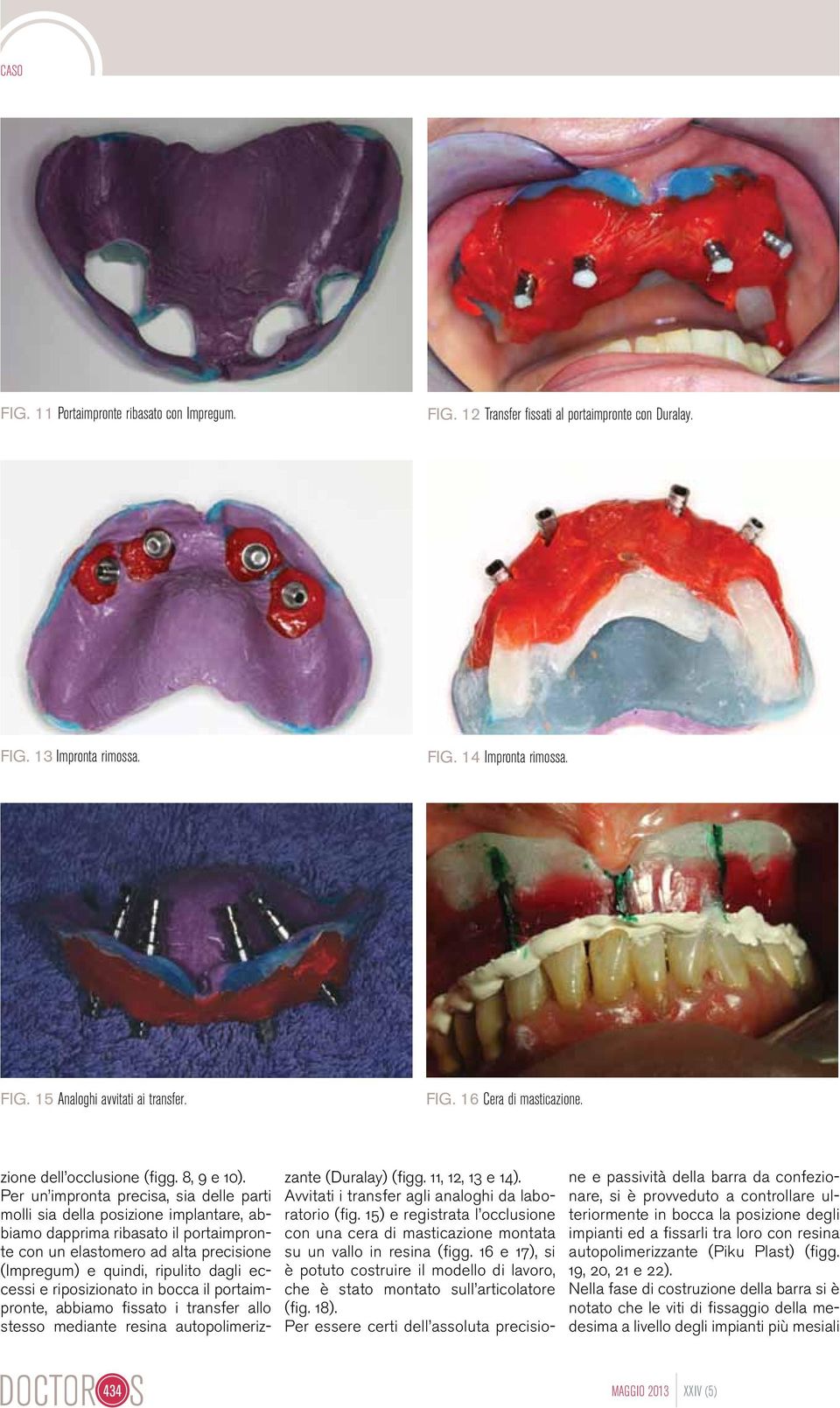 Per un impronta precisa, sia delle parti molli sia della posizione implantare, abbiamo dapprima ribasato il portaimpronte con un elastomero ad alta precisione (Impregum) e quindi, ripulito dagli