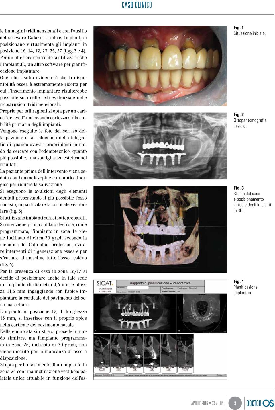 Quel che risulta evidente è che la disponibilità ossea è estremamente ridotta per cui l inserimento implantare risulterebbe possibile solo nelle sedi evidenziate nelle ricostruzioni tridimensionali.