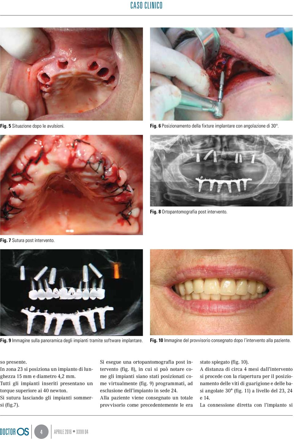 Tutti gli impianti inseriti presentano un torque superiore ai 40 newton. Si sutura lasciando gli impianti sommersi (fig.7). Si esegue una ortopantomografia post intervento (fig.