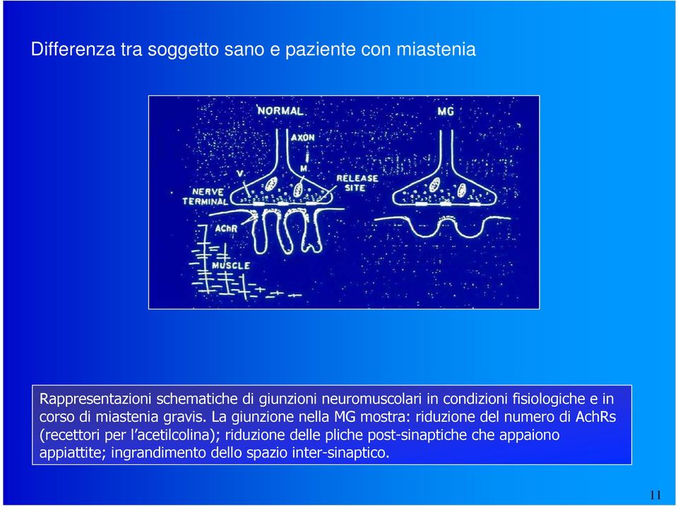 La giunzione nella MG mostra: riduzione del numero di AchRs (recettori per l acetilcolina);