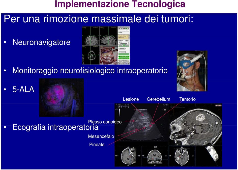 Neurochirurgia super-selettiva Neuronavigatore Monitoraggio