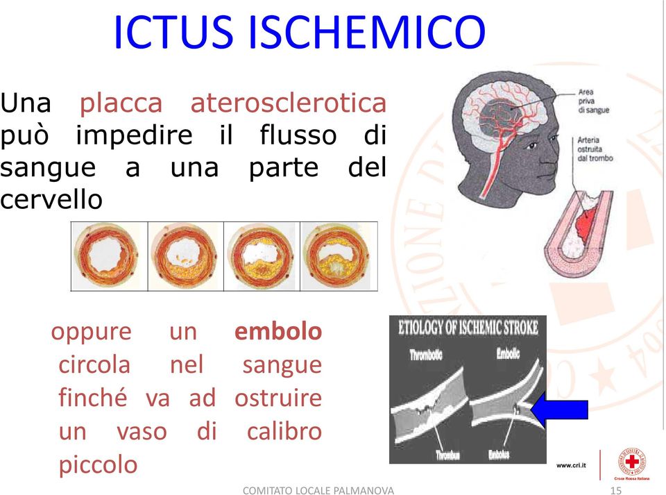 oppure un embolo circola nel sangue finché va ad