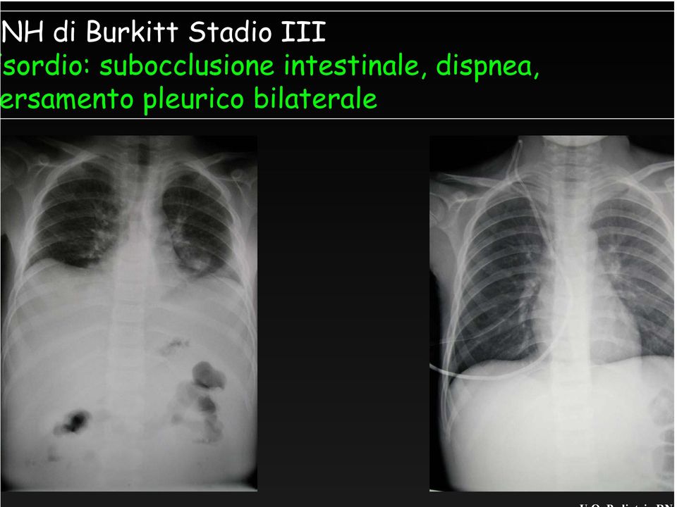 intestinale, dispnea,