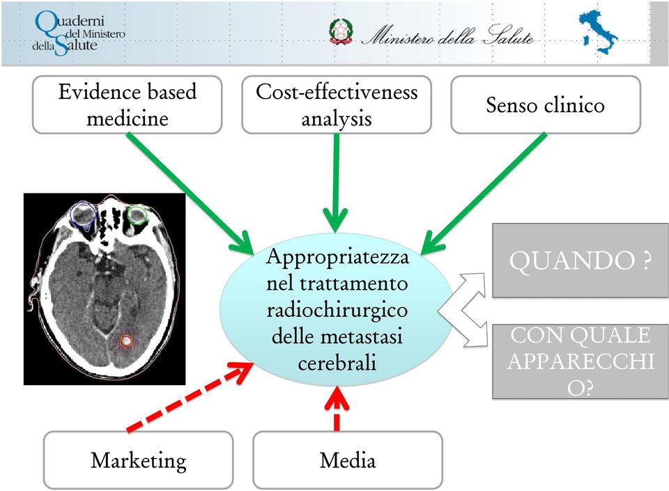 trattamento radiochirurgico delle metastasi