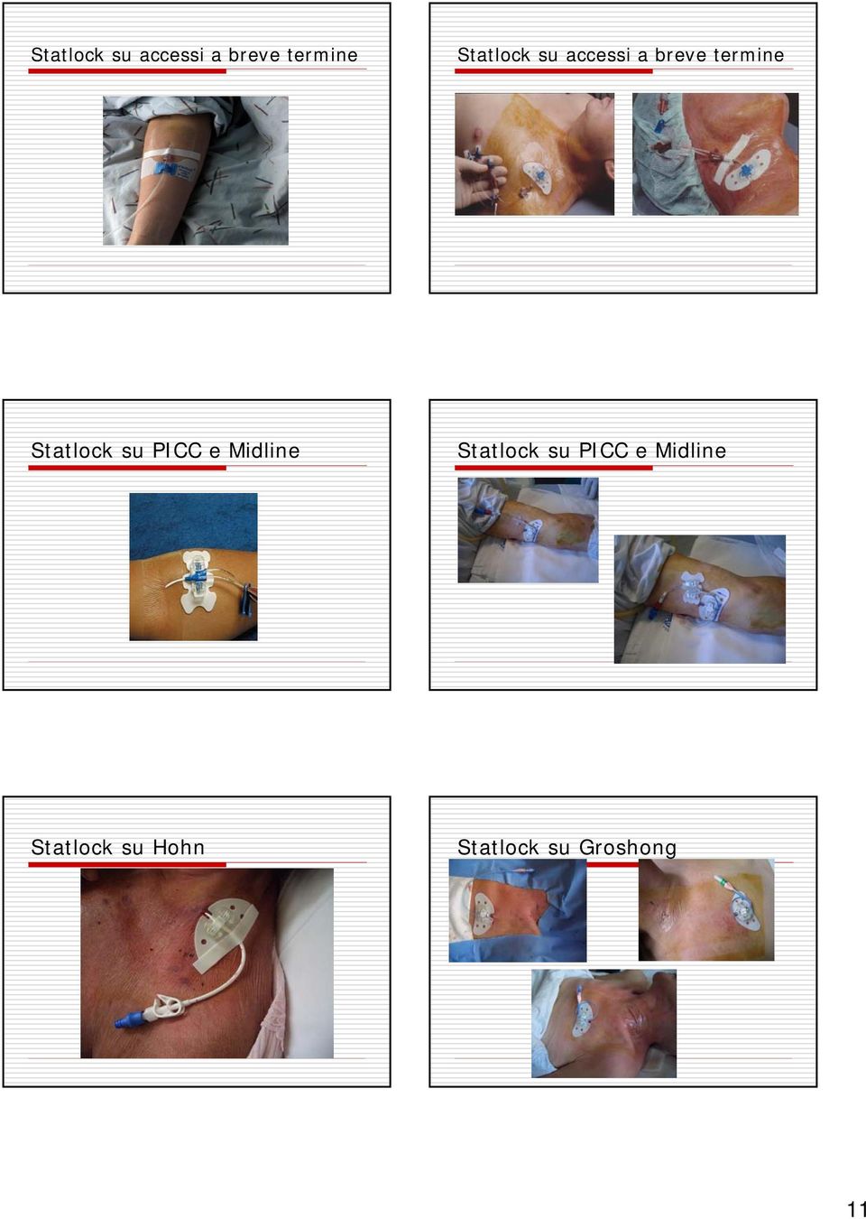 PICC e Midline Statlock su Hohn Statlock