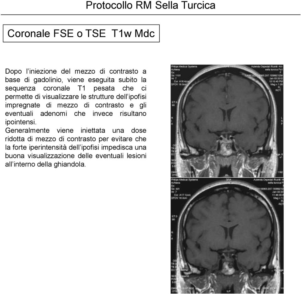 eventuali adenomi che invece risultano ipointensi.