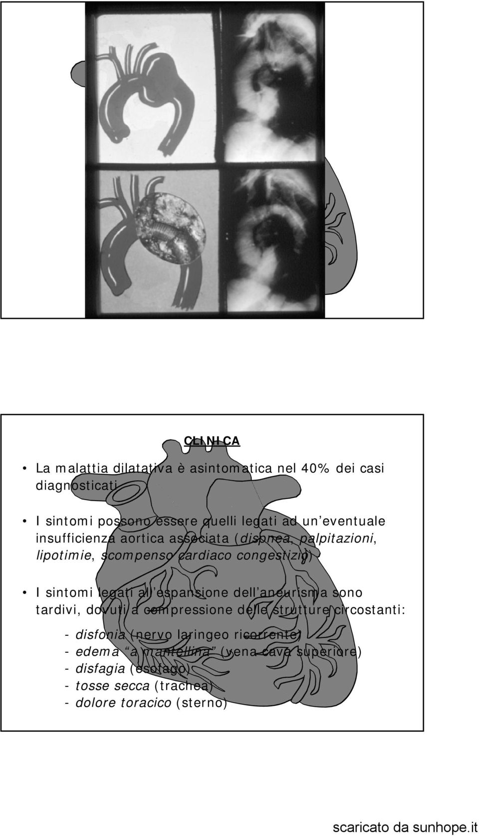 legati all espansione dell aneurisma sono tardivi, dovuti a compressione delle strutture circostanti: - disfonia (nervo