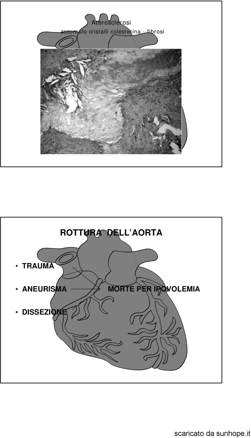 fibrosi ROTTURA DELL AORTA